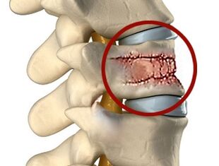 Muguras sāpju cēloņi var būt mugurkaula un starpskriemeļu disku slimības. 