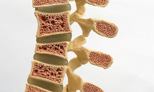Osteoporoze ir viens no muguras lejasdaļas sāpju cēloņiem