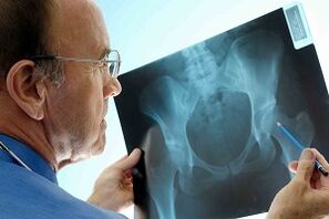 Gūžas locītavas artroze uz x -ray