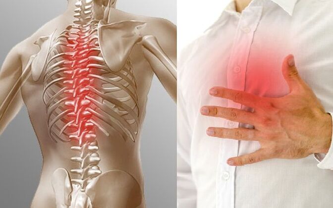 Krūškurvja osteohondroze un sāpes krūtīs