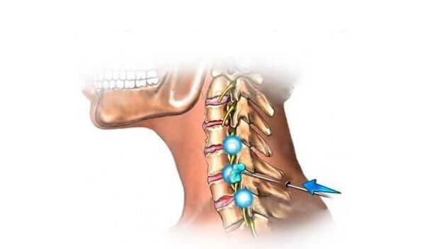 mugurkaula kakla daļas osteohondroze