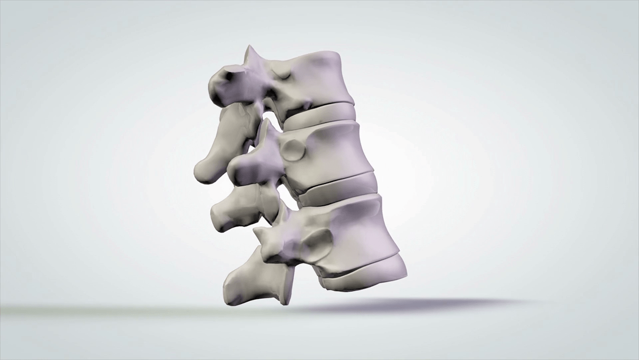 mugurkaula bojājumi dzemdes kakla osteohondrozes dēļ