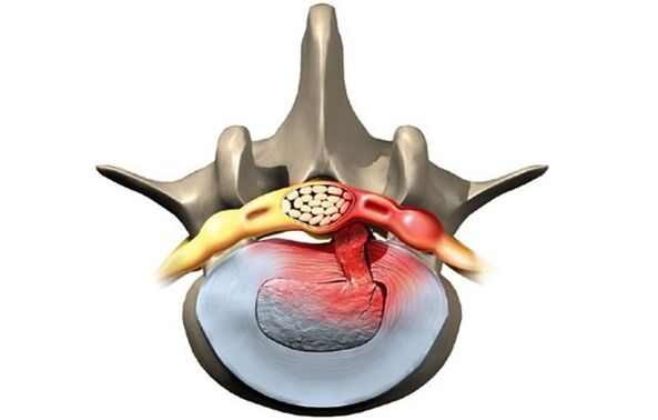 osteohondrozes skartais skriemelis