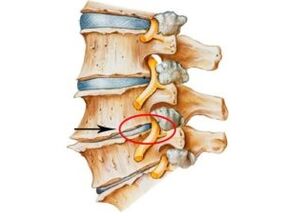 Osteohondrozes pazīmes un simptomi
