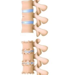 osteohondrozes cēloņi